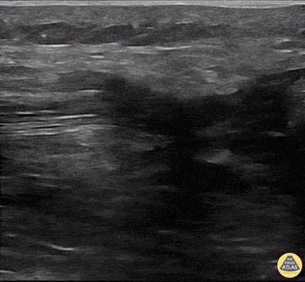 UPLOADS FOR REVIEW - Quadriceps Tendon Rupture