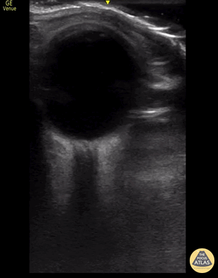 UPLOADS FOR REVIEW - Central Retinal Artery Occlusion