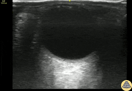 Orbital - Lens Subluxation