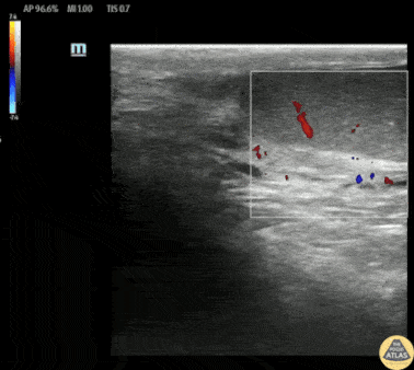 Pediatrics - Testicular Torsion