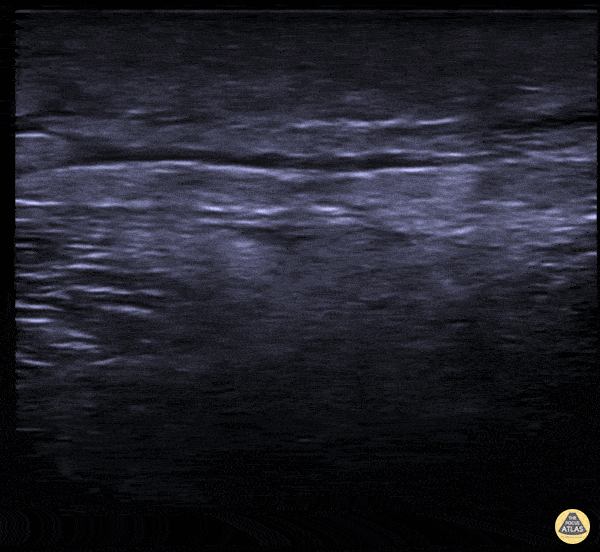 Soft Tissue - Necrotizing Fasciitis Following Puncture Wound