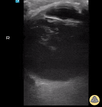 UPLOADS FOR REVIEW - Viterous Hemorrhage