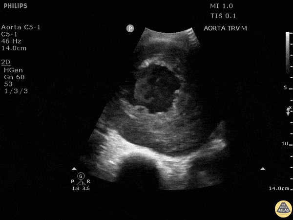 Aorta - Abdominal Aortic Aneurysm Presented As Cough