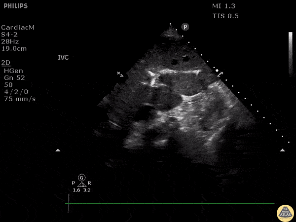 Biliary - Incidental Hepatic Arterial Calcification