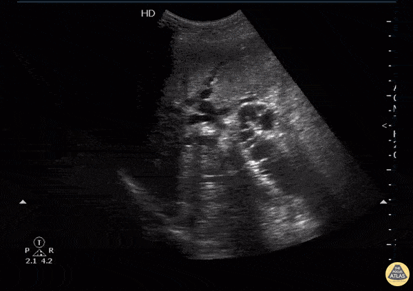 Biliary - Dilated cystic duct and spiral valves of Heister