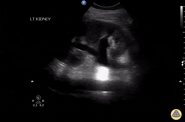 Renal/GU - Atypical Cause of Hydronephrosis