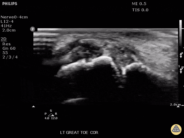Musculoskeletal - Monosodium urate crystals