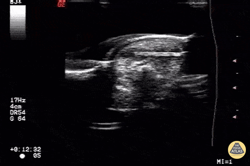 Trauma - Foreign body: wood piece