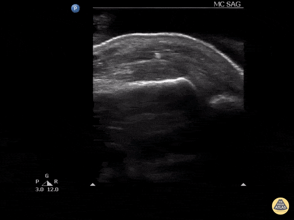 Trauma - Foreign body: glass