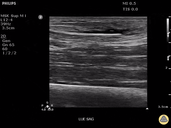 Trauma - Foreign body: bamboo