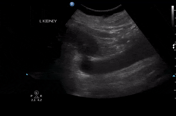 Renal/GU - Megaureter