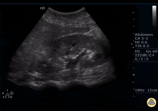 Renal/GU - Acute Focal Nephritis