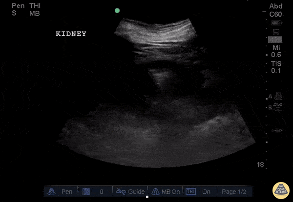 Renal/GU - Emphysematous Pyelonephritis