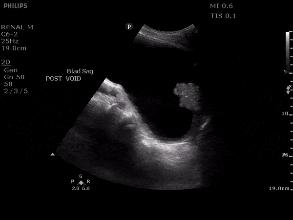 Renal/GU - Bladder cancer