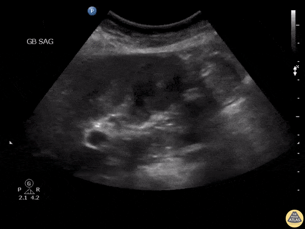 Biliary - Gallbladder cancer