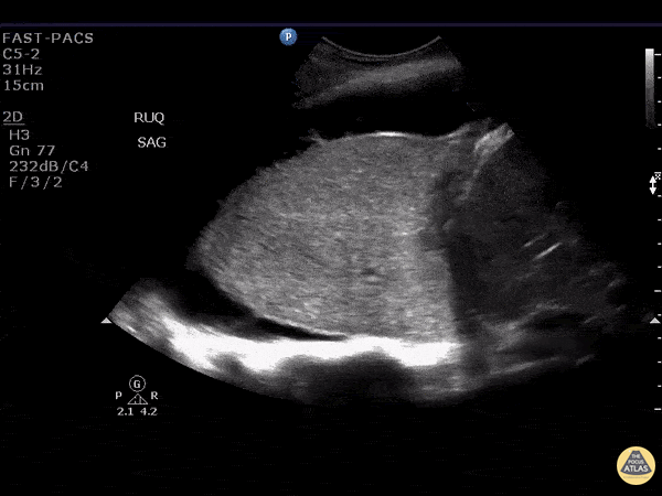 Pulmonary - Lung Consolidation from Bronchial Obstruction