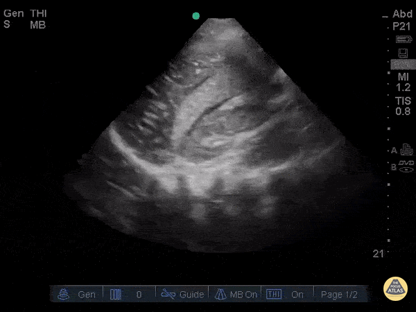 Trauma - Hemoperitoneum