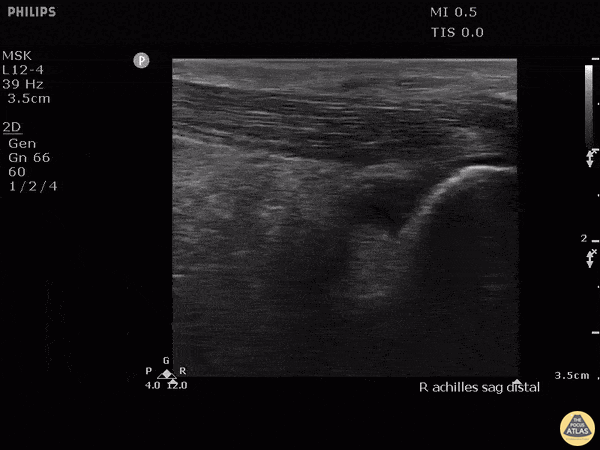 Musculoskeletal - Retrocalcaneal Bursitis