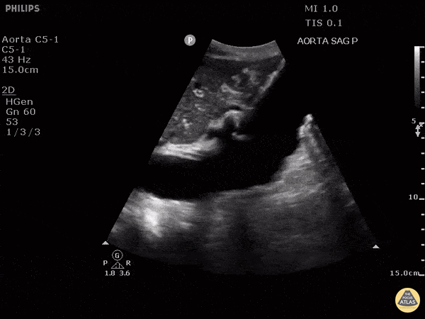 Aorta - Sagittal View of Abdominal Aortic Aneurysm