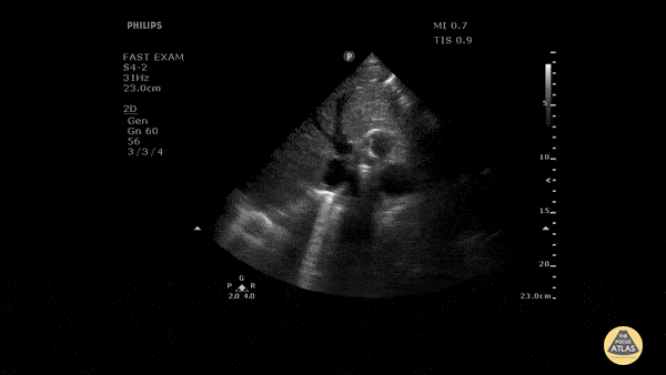 Aorta - Faint Dissection Flap in Descending Aorta