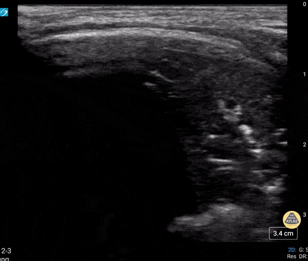 Peds-Lung - Dynamic Air Bronchograms