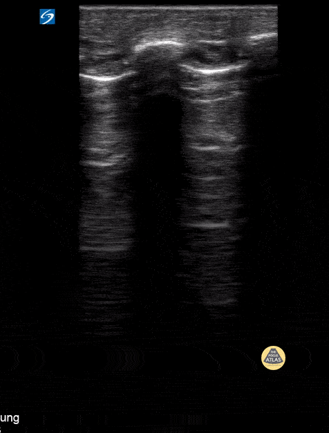 Peds-Lung - Lack of Lung Sliding