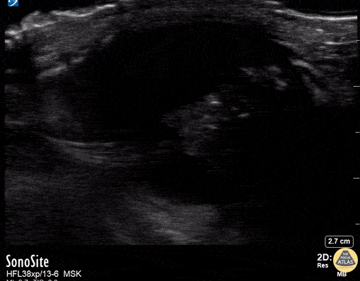 Peds-Orbital - Retinoblastoma