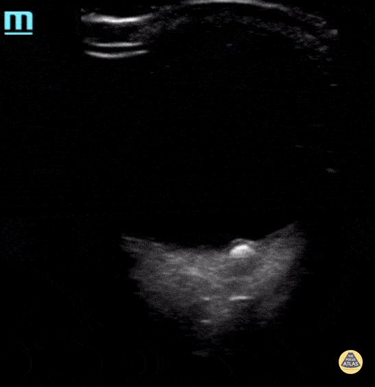 Peds-Orbital - Optic Disc Drusen