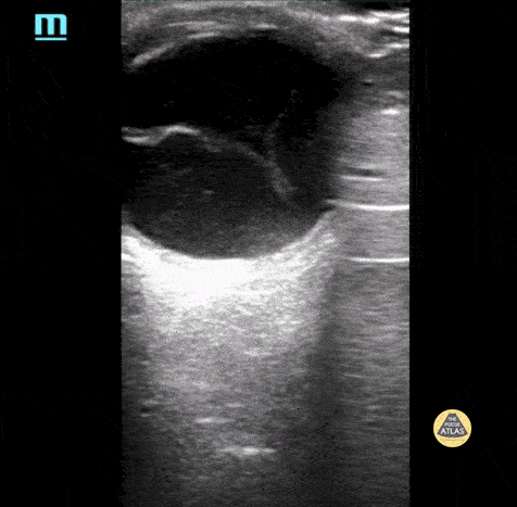 Peds-Orbital - Retinal Detachment