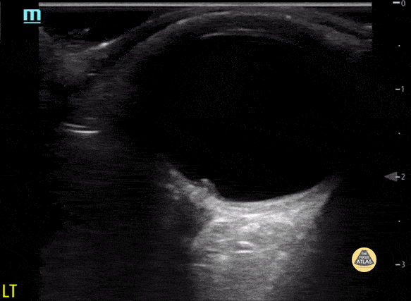 Peds-Orbital - Papilledema