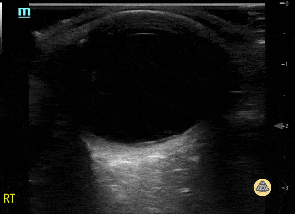 Peds-Orbital - Papilledema