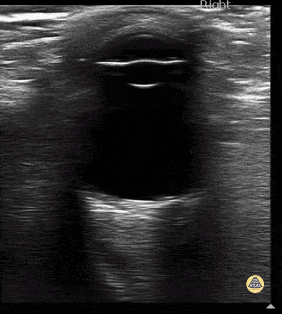 Peds-Orbital - Normal Eye