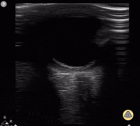 Peds-Orbital - Retinal Detachment