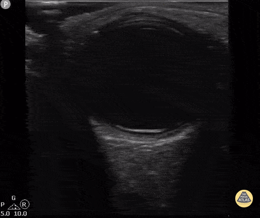 Peds-Orbital - Retinal Detachment, 8 yo
