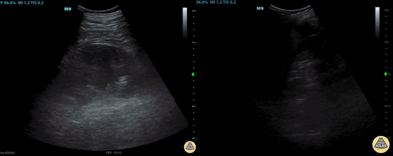 Renal/GU - Subcapsular Renal Hematoma