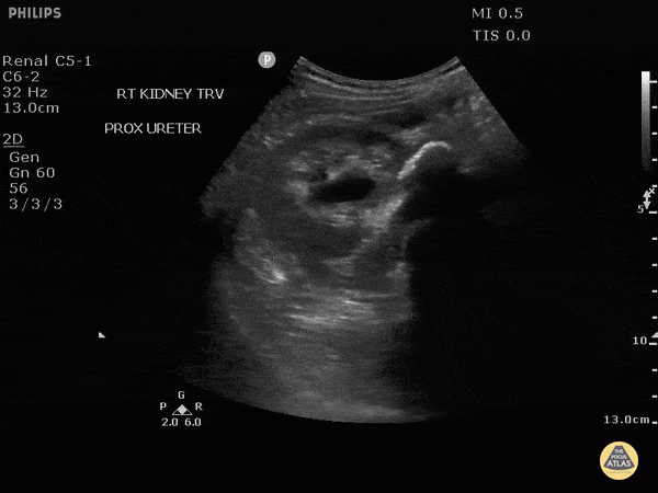Renal/GU - Pyonephrosis in Setting of Proximal Ureteral Stone
