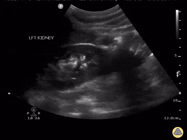 Renal/GU - Renal Abscess
