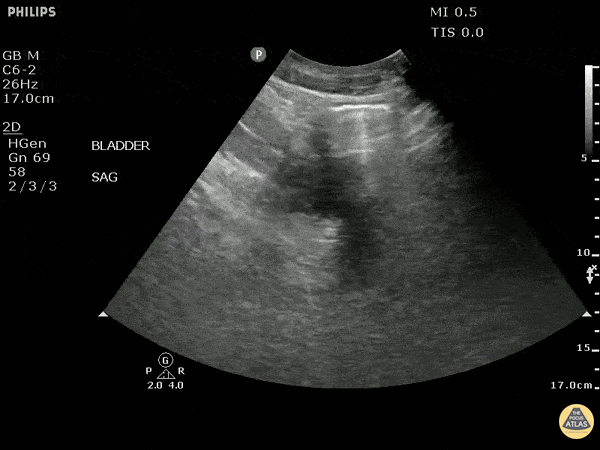 Renal/GU - Air Within Bladder