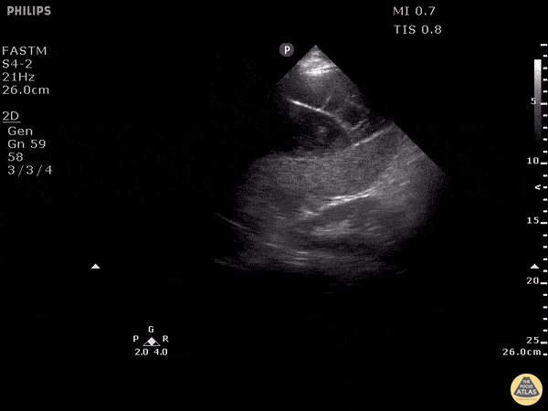 Trauma - Subcapsular Splenic Hematoma