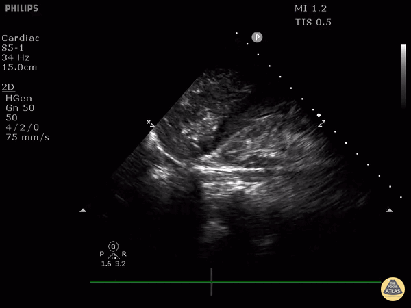 Bowel-GI - Portal Venous Gas From Diverticular Abscess