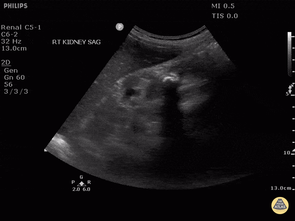 Renal/GU - Medullary Nephrocalcinosis