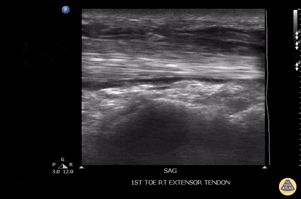 Musculoskeletal - Tenosynovitis Of The Extensor Hallucis Longus Tendon