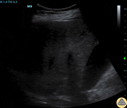 Renal/GU - Pheochromocytoma