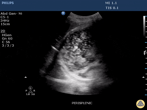 Bowel-GI - Full Stomach