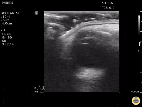 Orbital - Metallic Foreign Body In Orbital Soft Tissue