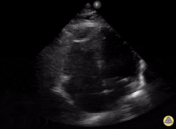 Right Ventricular Dysfunction - McConnell's Sign Due to NSTEMI