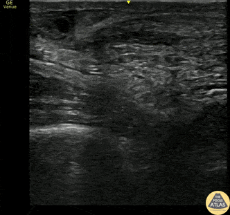 Musculoskeletal - Achilles Tendon Rupture