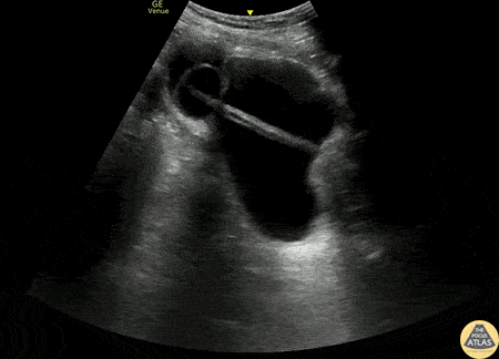 Renal/GU - Bladder Diverticulum