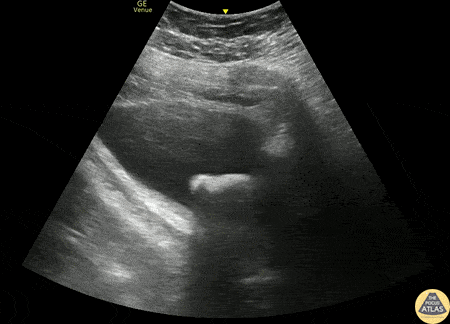 Renal/GU - Bladder Stone