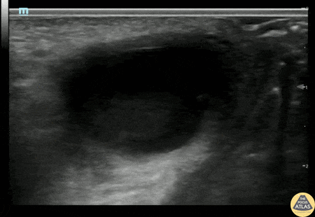 OB/Gyn - Bartholin's Abscess